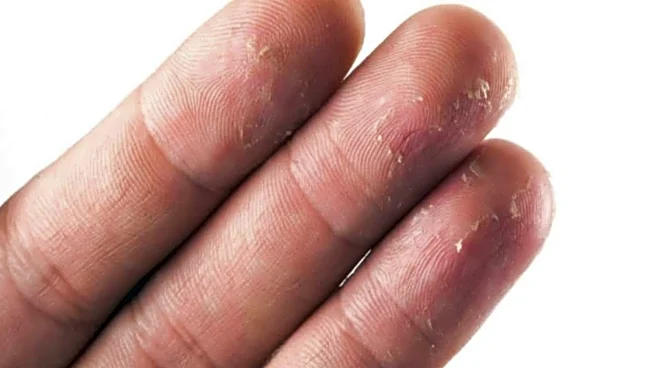 Fix dry finger tips with these simple hacks