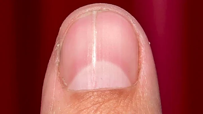 Fix nail discoloration with these kitchen hacks