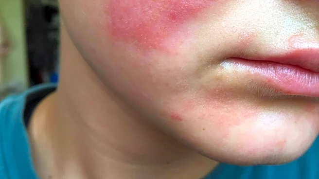 Fix cheek burning with these home remedies