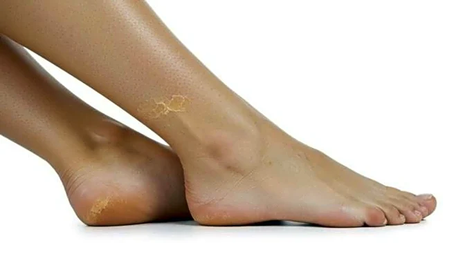 What really causes cracked heels?
