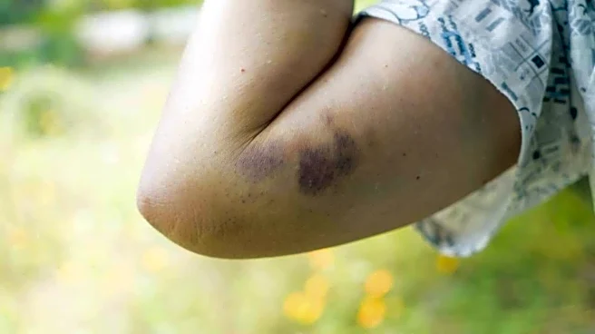 These home remedies may bring relief to forearm bruises