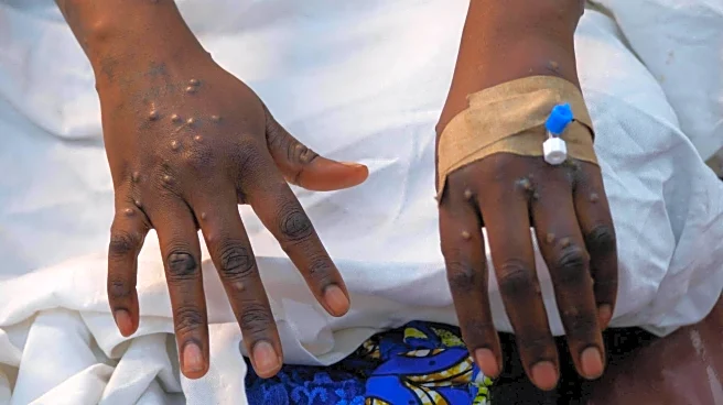 Ethiopia confirms deadly Marburg virus outbreak: Know symptoms and risks