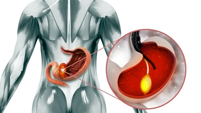 Stomach Cancer Warning: 5 Silent Symptoms You Might Miss