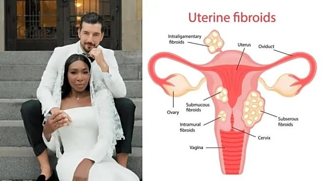 Venus Williams Marries Andrea Preti: What Is Adenomyoma and How the Diagnosis Strengthened Their Bond