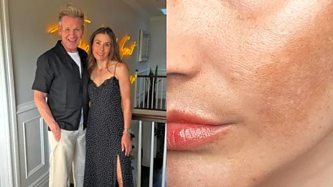 Gordon Ramsay’s Wife Tana Reveals Melasma After Sun Exposure—What Is This Skin Condition?