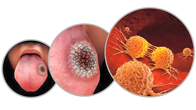Cancer Warning Signs: Is Your Tongue Trying to Tell You Something?