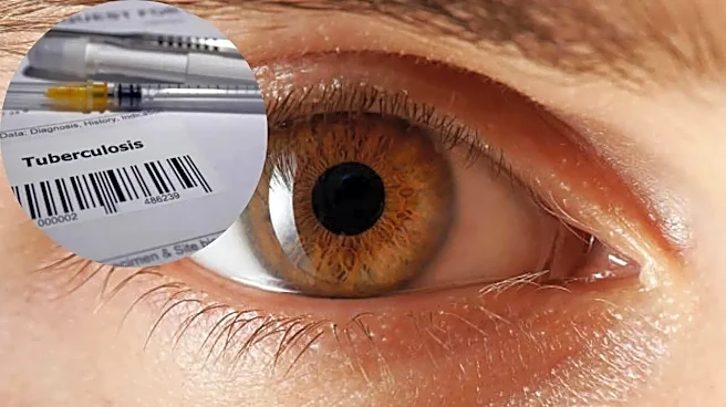 Eye Tuberculosis Inflammation Can Persist After Cure, Study Warns