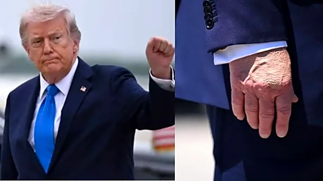 Donald Trump’s Discoloured Hand Sparks Fresh Rumours After Florida Appearance