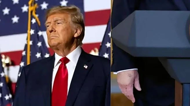 Donald Trump Health Buzz Grows After Viral Photos Show ‘Swollen’ and Bruised Hands