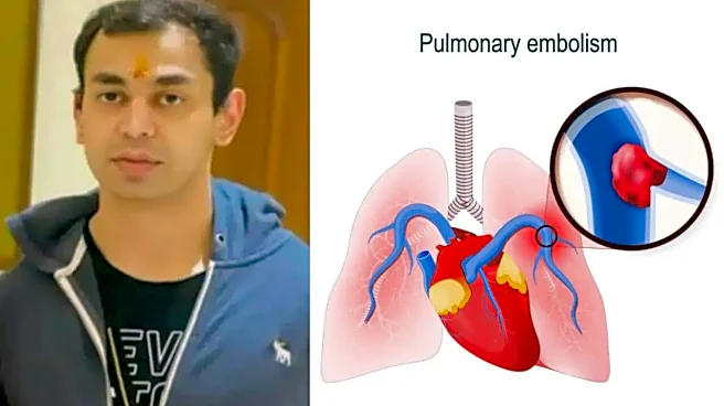 What is Massive Pulmonary Thromboembolism, The Lung Clot Condition That Caused Prateek Yadav’s Death