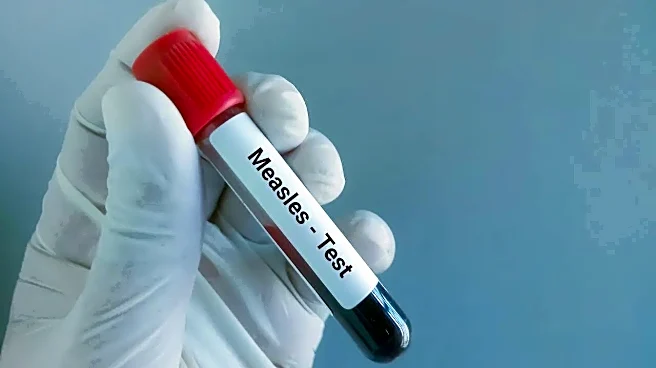 Bangladesh Measles Outbreak Kills 7 Children In 24 Hours; Death Toll Rises To 601