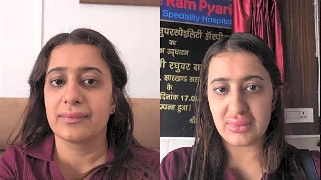 Woman Claims She Got 'Severe' Allergy, Her Son Suffered From Diarrhoea After Eating On Vande Bharat Train