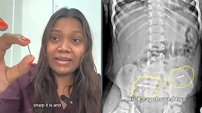 Metal Wires Found Hidden In Birthday Cake After 3-Year-Old Swallows Them, Mother Shares Video
