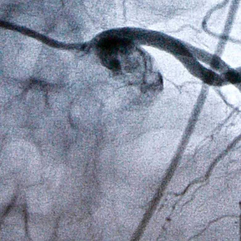 Experimental cholesterol-lowering pill may offer new option for millions