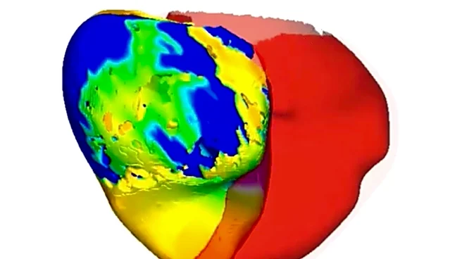 To fix a patient's irregular heartbeat, doctors first tested its digital 'twin'