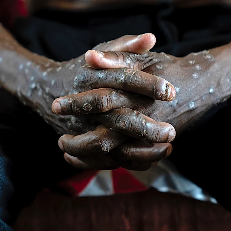 Congo says its mpox outbreak is over after 2 years and more than 2,200 suspected deaths