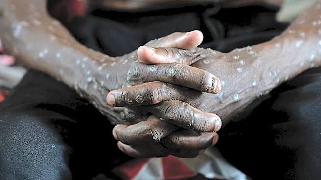 Congo says its mpox outbreak is over after 2 years and more than 2,200 suspected deaths