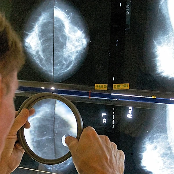 When should you get a mammogram? Conflicting advice makes it hard to know