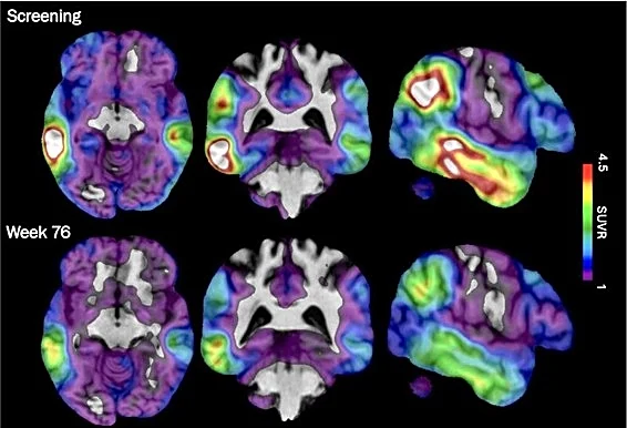 An experimental Alzheimer's drug shows promise targeting a different brain protein, new study shows