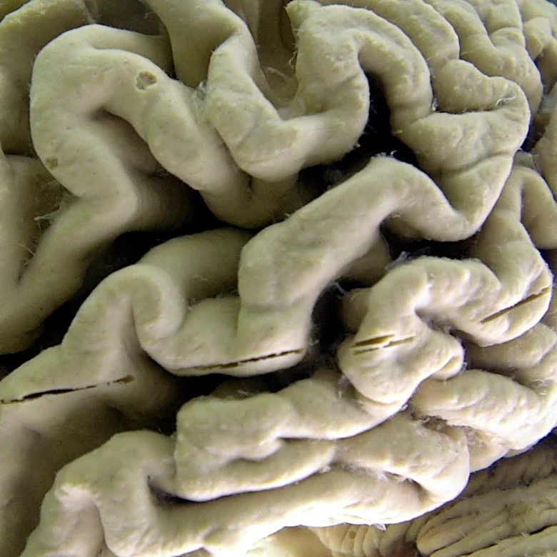 Study shows a blood test can help identify healthy people at high risk for Alzheimer's disease