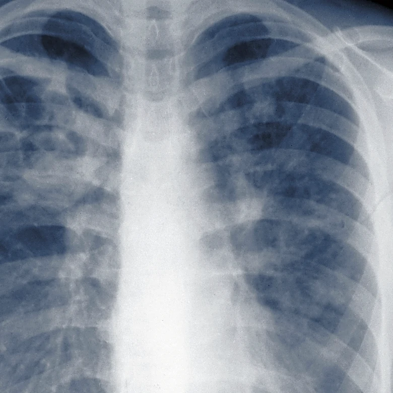 Study suggests the threat of mold-associated illnesses may be underappreciated