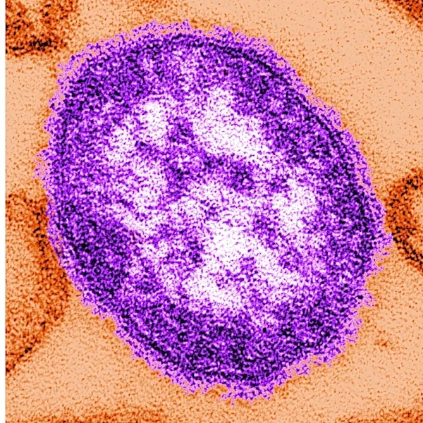 Coroner releases details of infants who died amid growing Pennsylvania measles outbreak