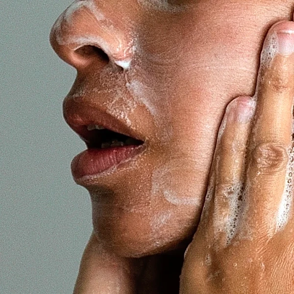Adult acne is real, but there are ways to treat it. Here's what to know