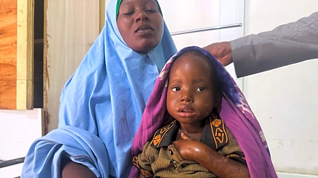 Mother's 3-day walk with sick daughter highlights Somalia's child malnutrition emergency