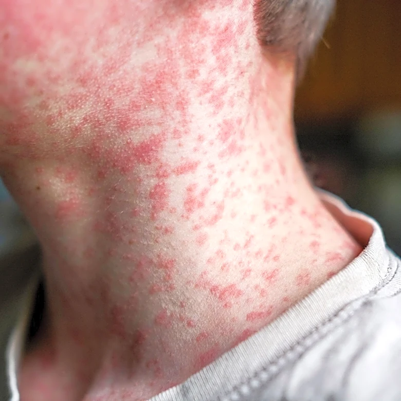 A person with measles was at this drug store in metro Phoenix