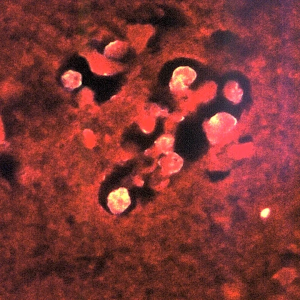 North Carolina teen critically ill with brain-eating amoeba