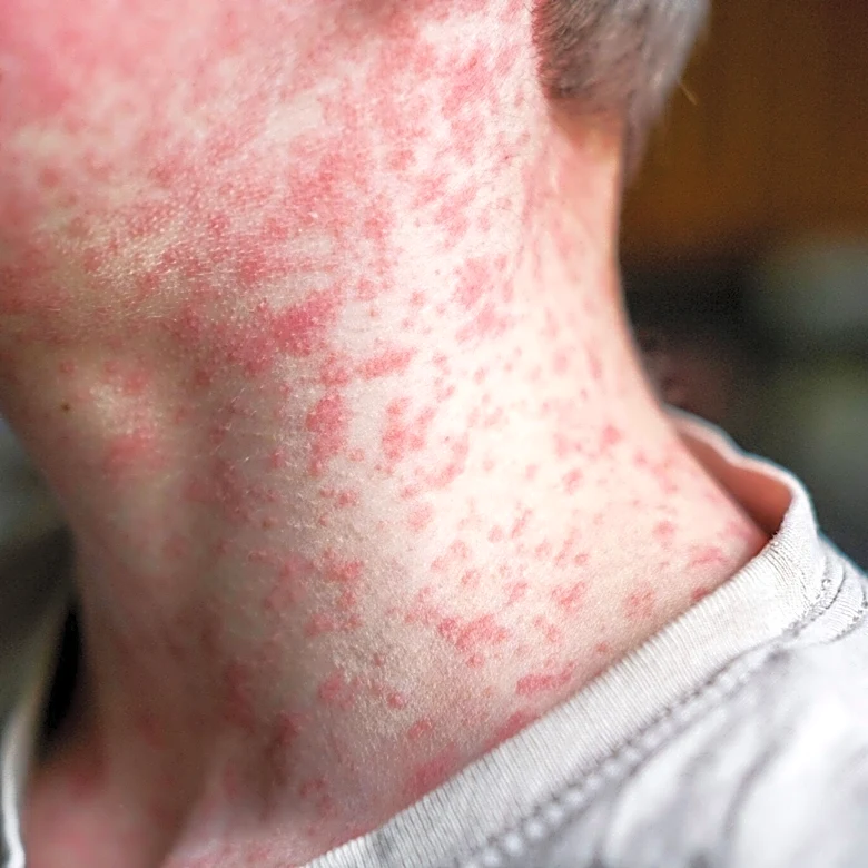 Possible measles exposure in Buncombe, Henderson counties. See locations