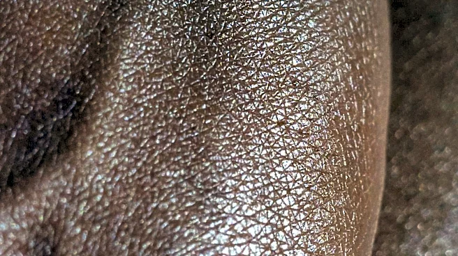 What Are the Most Common Signs of Ichthyosis?