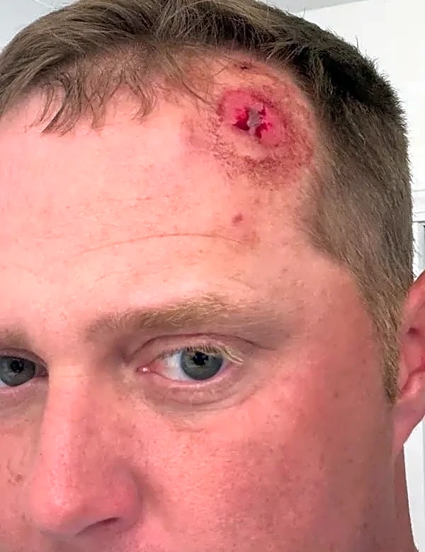Michigan golf pro 'really fortunate' after being KO'd by ball to head