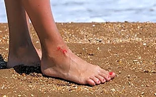Where Vibrio vulnificus cases rise in Florida after 2 new reports