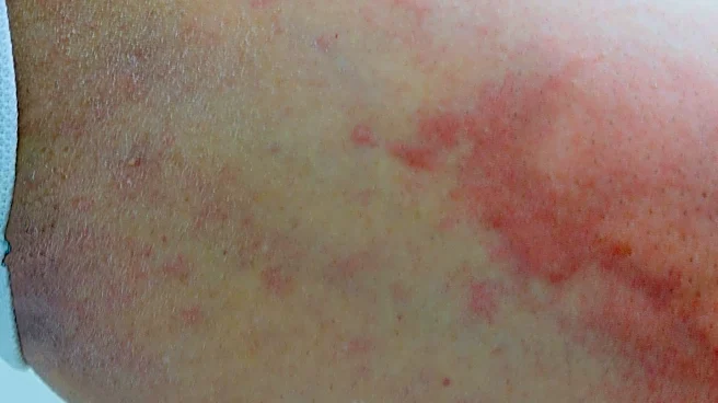 Climate Change Drives Surge in Dengue Fever Cases, Warn Health Officials