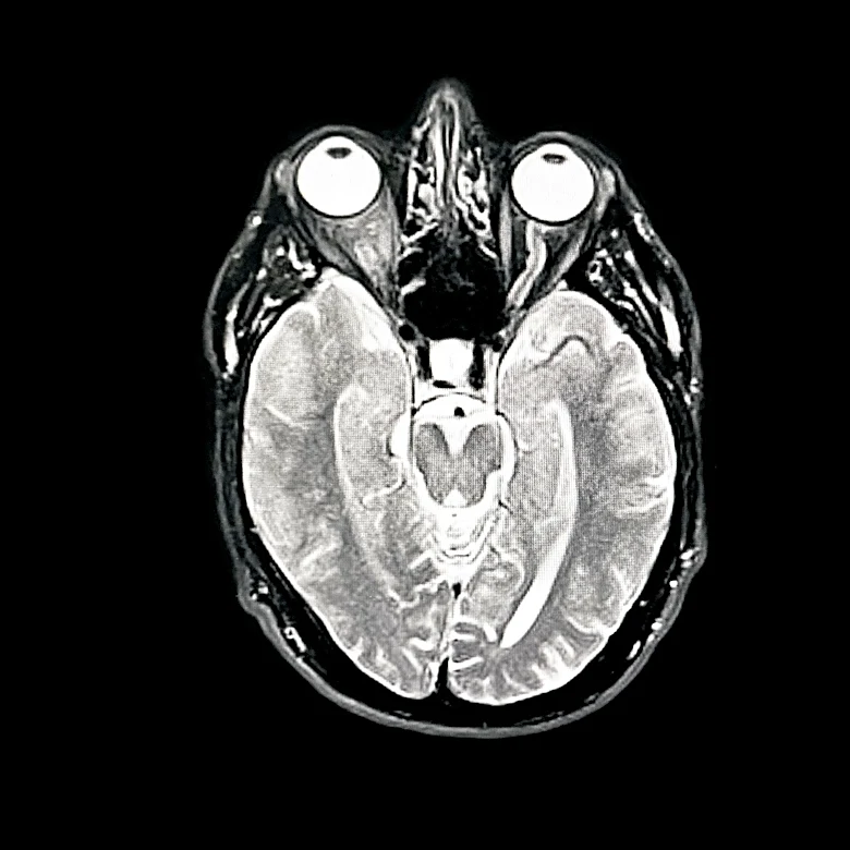 Research Identifies Mechanism Limiting Brain Repair After Stroke