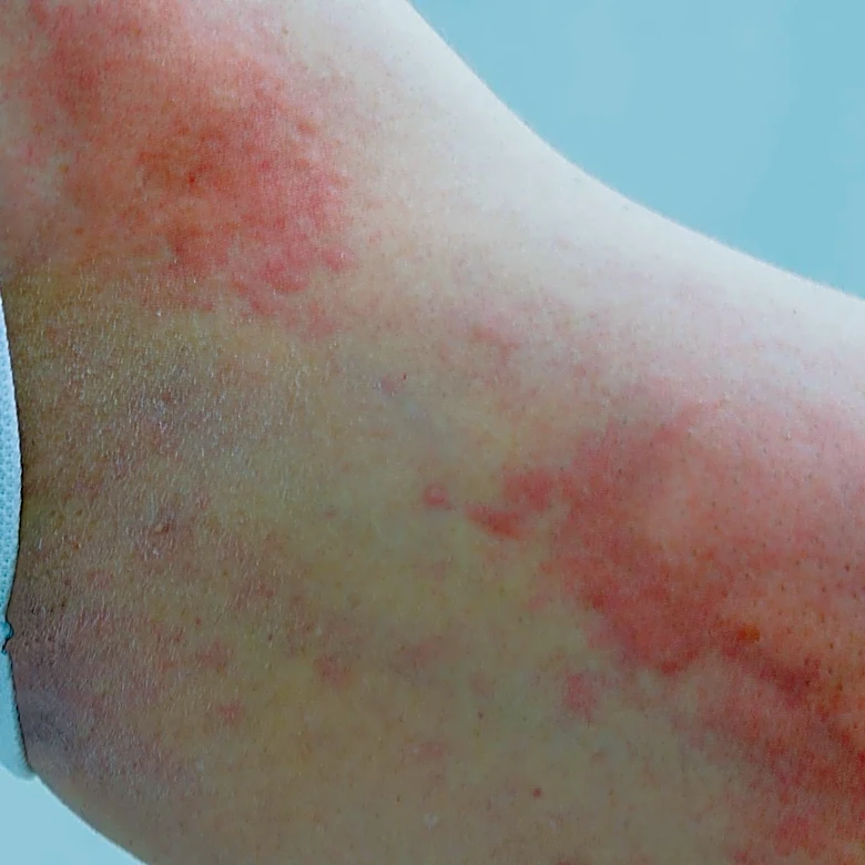 Study Reveals Bacterial Infection Risks in Hospitalized Firearm Injury Patients