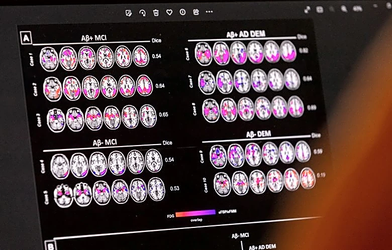 Analysis-Alzheimer's drug hunt learns from cancer fight's multi-target playbook