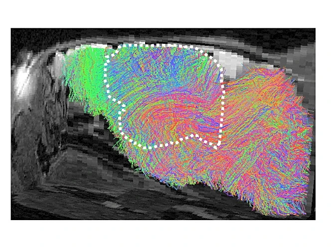 Scientists transplant lab-grown human brain tissue into mice