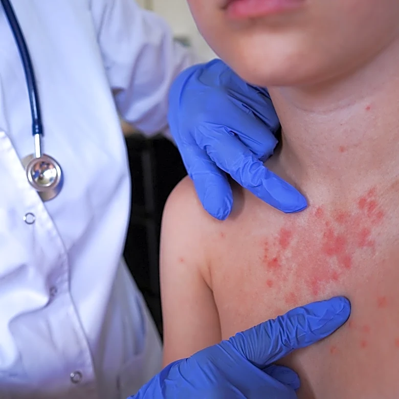 Measles cases rise in Georgia as outbreak spreads