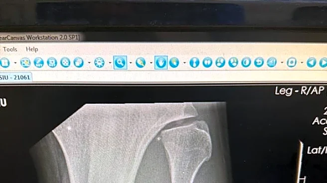 Valter Walker suffered broken fibula in UFC 321 win, reveals recovery timeline