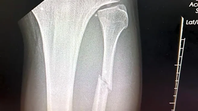 Pic: UFC 321 ‘Monster’ who made submission history did it with a broken leg