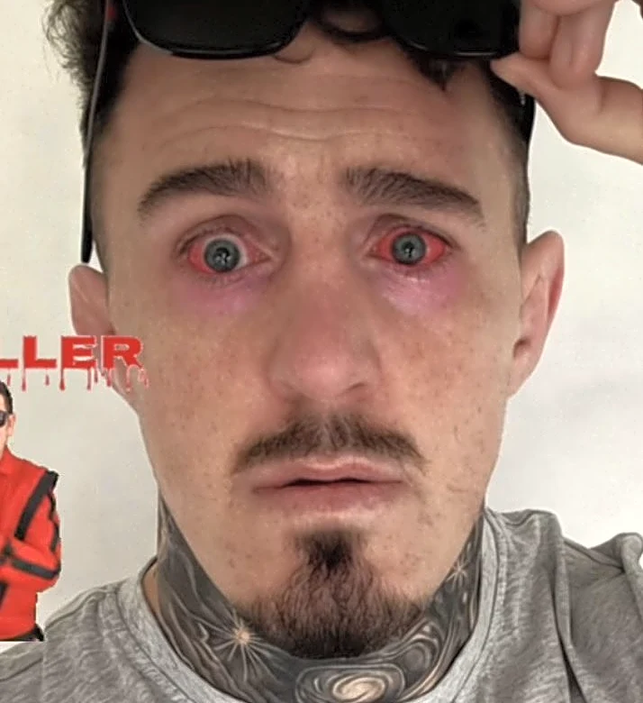 Tom Aspinall shows off horrific red eyes ‘1 day post surgery’