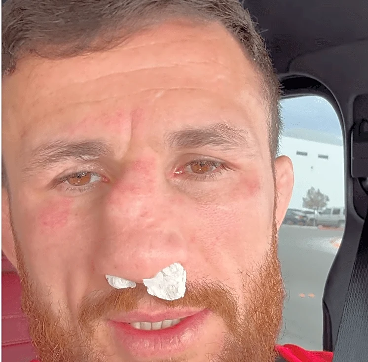 Merab Dvalishvili smashes nose in training, refusing surgery until retirement