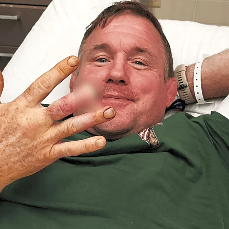 Pic: UFC Hall of Famer Matt Hughes reveals gruesome finger amputation – ‘Nine more to work with’