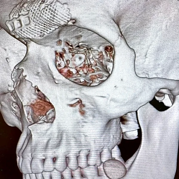 Marco Tulio: No fear ahead of UFC 328 despite surgeries to reconstruct forehead bone after knockout loss