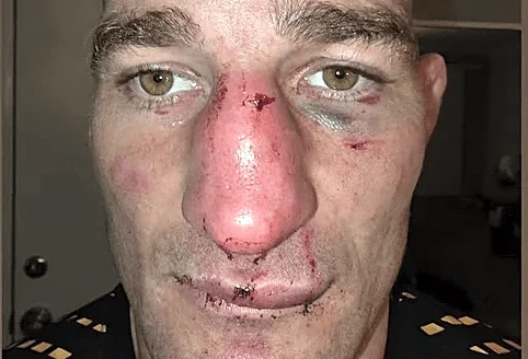 Pic: Sean Strickland shows off gruesome broken nose after UFC 328 title win