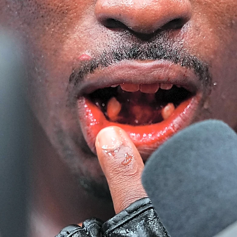Tresean Gore transported to hospital following teeth-busting UFC 330 win