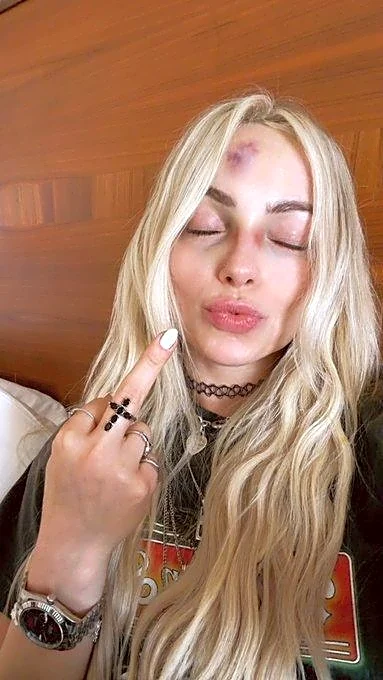 Liv Morgan needed steroids & fat grafts to deal with that hematoma from Raw