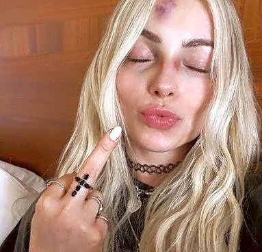Liv Morgan needed steroids & fat grafts to deal with that hematoma from Raw
